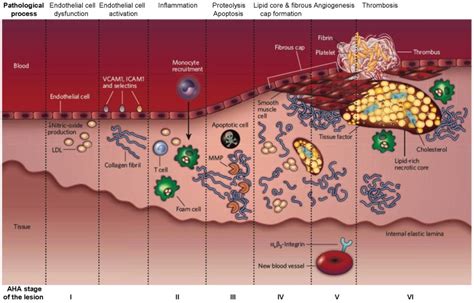 The Developmental Stages Of An Atherosclerotic Lesion Aha American