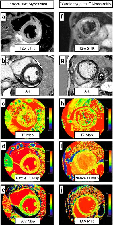 Comparison Of Typical Cmr Findings In “infarct Like” And Download