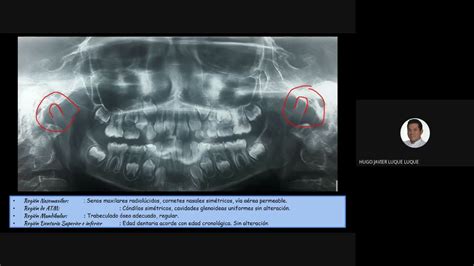 10 ANÁLISIS RADIOGRAFÍA PANORÁMICA YouTube