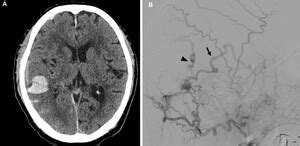 Single Session Hematoma Removal And Transcortical Venous Approach For