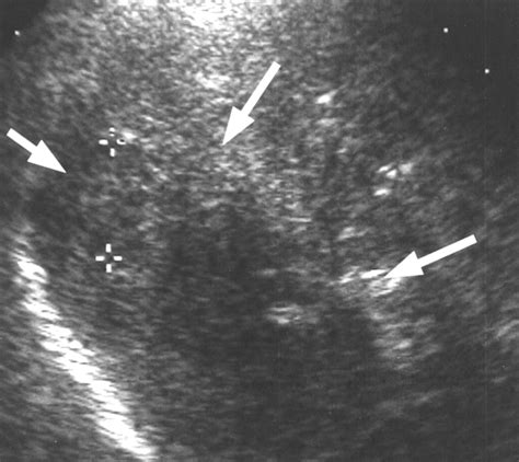 Carbon Dioxideenhanced Sonographically Guided Percutaneous Ethanol