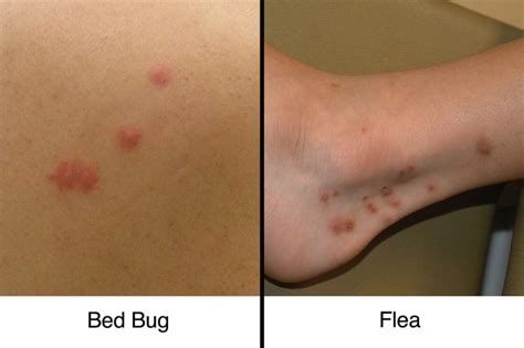 Flea Bites Vs Bed Bug Bites On Humans