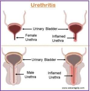 Urethritis Causes Signs And Symptoms Management We Care