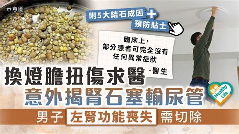 腰痛注意︳換燈膽扭傷求醫 意外揭腎石塞輸尿管 男子左腎功能喪失需切除︳附5大結石成因 預防貼士 晴報 健康 其他疾病 D220903