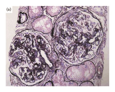 Light Microscopy Findings In The Renal Biopsy Specimen Glomeruli