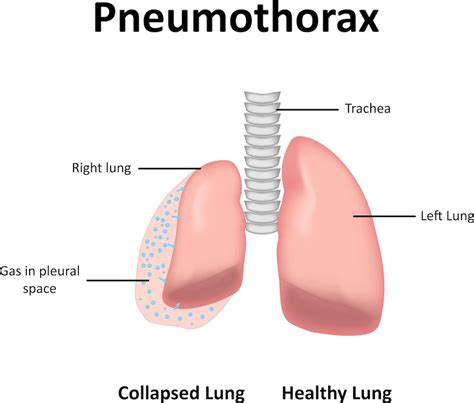 Pneumothorax Right Lung Pediatric Pulmonologists