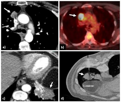 In A, an axial CT scan with a mediastinal window setting shows an ...