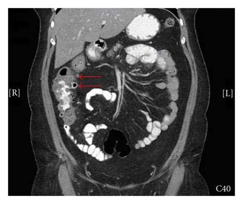 Coronal Ct Image Demonstrating Right Sided Colonic Diverticulitis