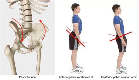 How To Fix Rotated Pelvis With Clinical Somatics Exercises