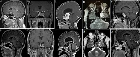 Representative Preoperative And Postoperative Magnetic Resonance Download Scientific Diagram