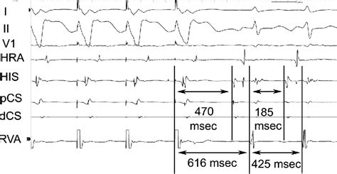 Entrainment For Distinguishing Atypical Atrioventricular Node Reentrant