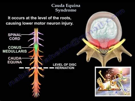 Spinal Cord Anatomy Cauda Equina