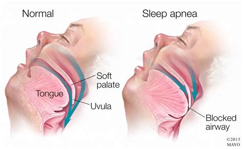 Apnea Notturna Sintomi E Diagnosi