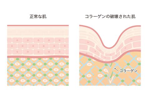 たるみの原因・治療方法｜ 東京・銀座でしわ・たるみ治療・エイジングケアなら銀座たるみクリニック