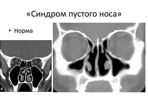 Атрофический ринит - online presentation