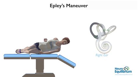 Epley Maneuver A Step By Step Guide To Treat BPPV Vertigo YouTube