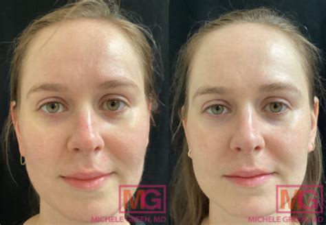 Laser Toning For Skin Dr Michele Green Md