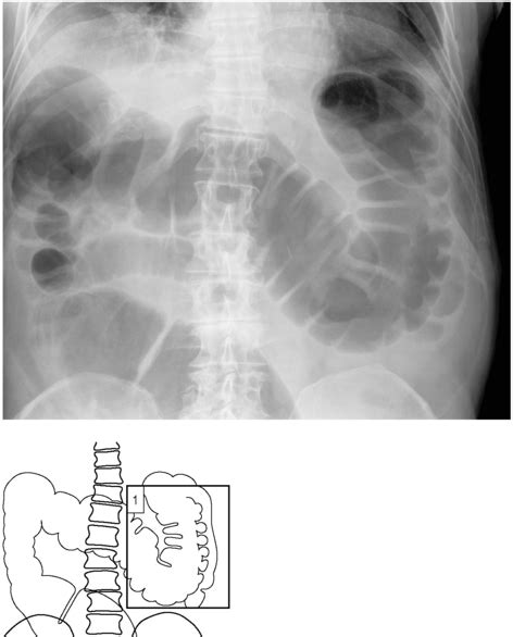 Large Bowel Obstruction Radiology Key