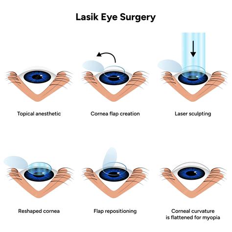 Procedimiento De Las Etapas De La Cirugía Ocular Lasik Vector Premium