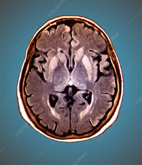 Brain In Creutzfeldt Jakob Disease Mri Stock Image C