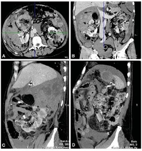 Postcontrast Multiple Detector Computed Tomography Mdct A Sagittal Download Scientific