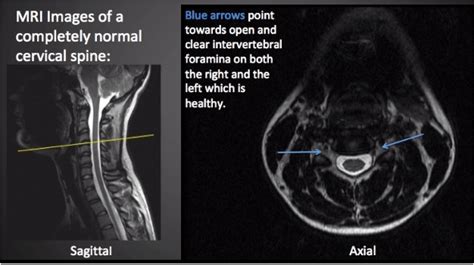 The Pinched Nerve in Your Neck Most Likely Isn't Actually a Pinched Nerve