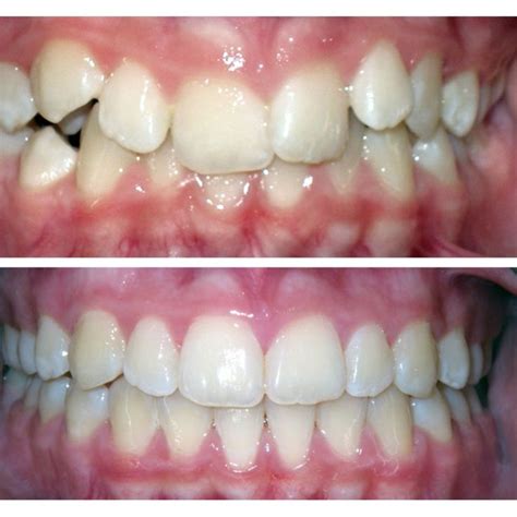 Straighten Teeth Without Metal Braces Orthosnap As Effective As