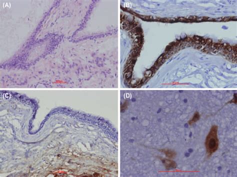 Postoperative Pathological Examinations A Hematoxylin And Eosin He