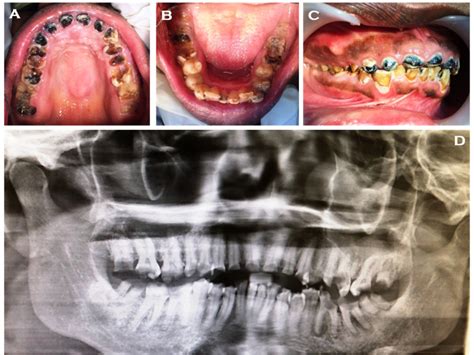 Figure A Maxillary Arch Showing Decayed Teeth B Mandibular Arch