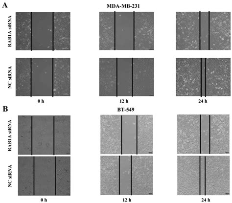 Inhibition of RAB1A suppresses epithelial-mesenchymal transition and ...