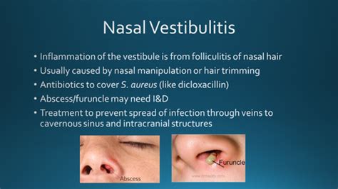 L04 Nasal Sinus Problems Flashcards Quizlet