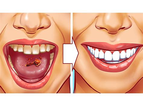 10 Tips To Get Rid Of Tartar In Teeth Naturally