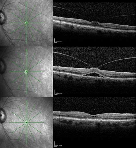 Upper Panel Spectral Domain Optical Coherence Tomography Of A Download Scientific Diagram