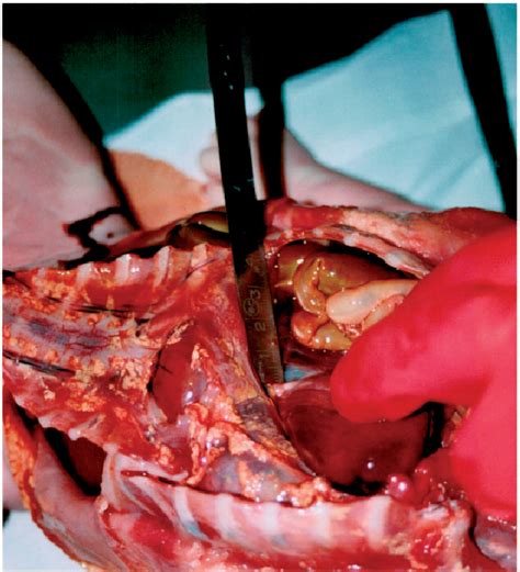 Figure 1 From Autopsy Features In A Newborn Baby Affected By A Central