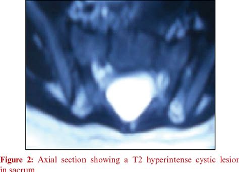 Figure 1 From Pediatric Symptomatic Sacral Extradural Arachnoid Cyst