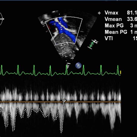 Technique For Obtaining The Velocity Time Integral Of The Inferior Vena