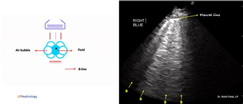 Basics of Lung Ultrasound for the Nephrologist: What are A-lines and B ...