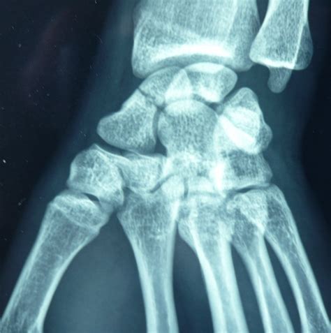 fracture du scaphoide carpien Institut Européen de la Main