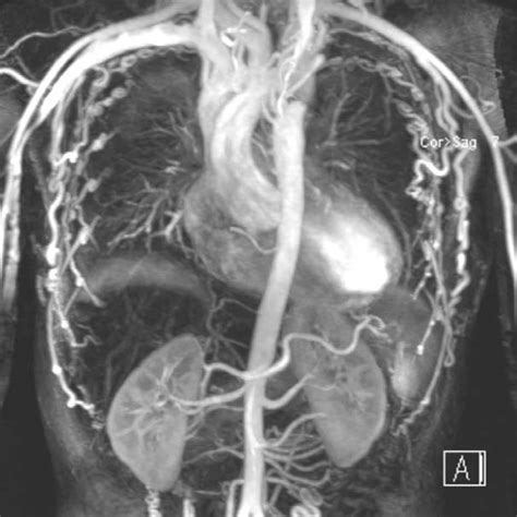 Cardiac Magnetic Resonance Shows Severe Coarctation At The Level Of The Download Scientific