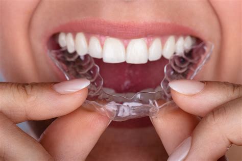 Does Invisalign Really Work Bella Dental Of Holmdel