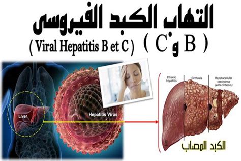 15 ملـيـــون مــصاب بـ التـهـاب الـكبد الفيروسي في الجــزائر