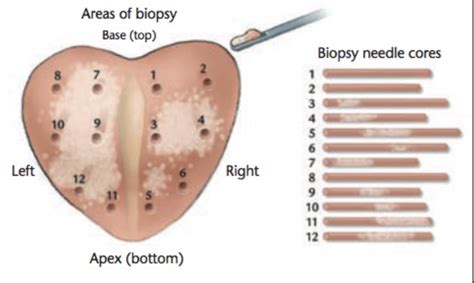 Saturation Biopsy Prostate