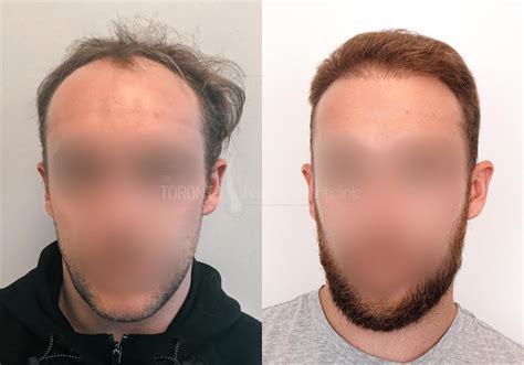 Fue Hair Transplant • Fue Toronto The Toronto Hair Transplant Clinic