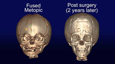 Metopic Suture