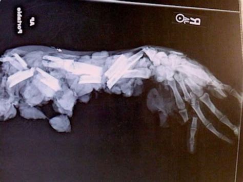 X Ray Of A Hand After A Meat Grinder Accident In Case You Thought You