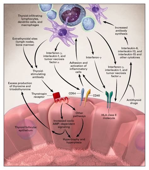 Graves Disease Nejm