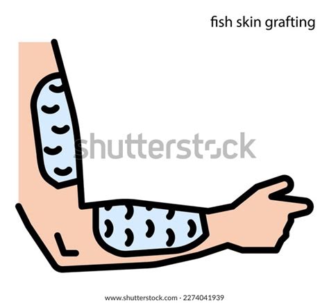 Fish Skin Grafting Wound Healing Stock Vector (Royalty Free) 2274041939 | Shutterstock