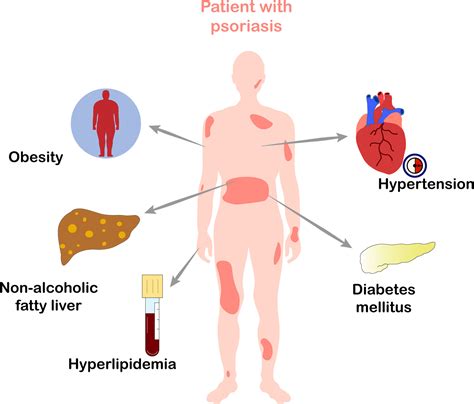 Frontiers Metabolic Syndrome And Psoriasis Mechanisms And Future