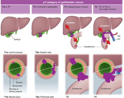 Cancer And Benign Lesions Bile Duct Gall Bladder Flashcards Quizlet