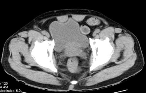 Bladder Hernia With Inguinal Hernia Herniation Of Right Inferior